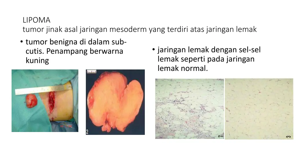 lipoma tumor jinak asal jaringan mesoderm yang