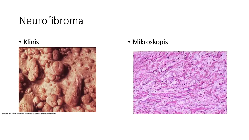 neurofibroma