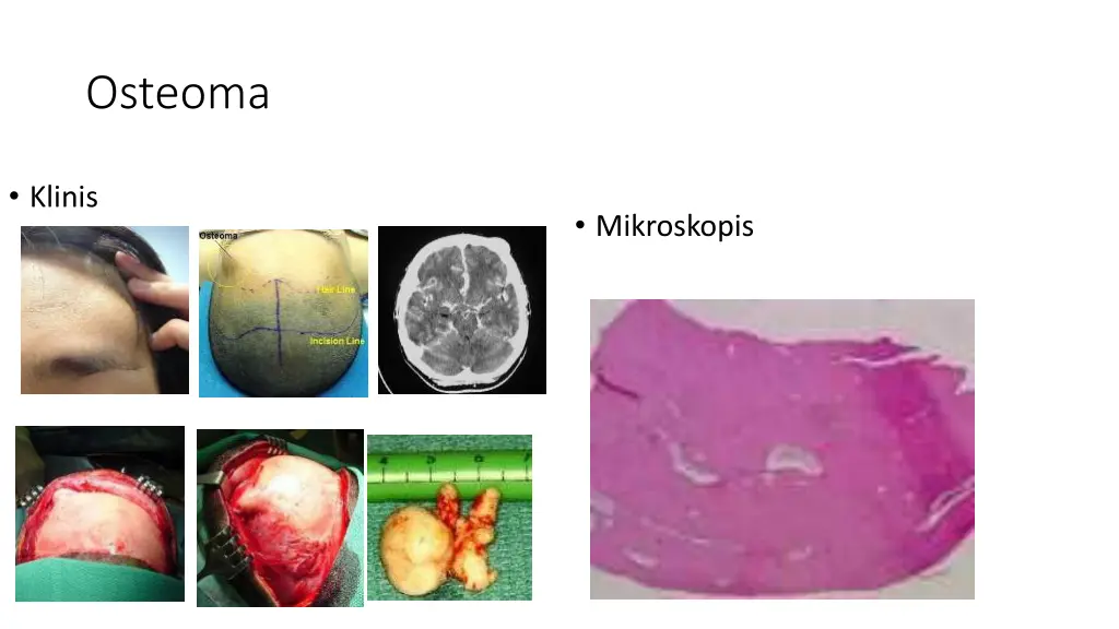 osteoma
