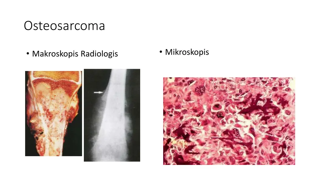 osteosarcoma