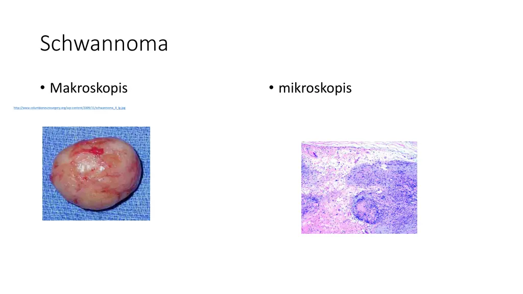 schwannoma