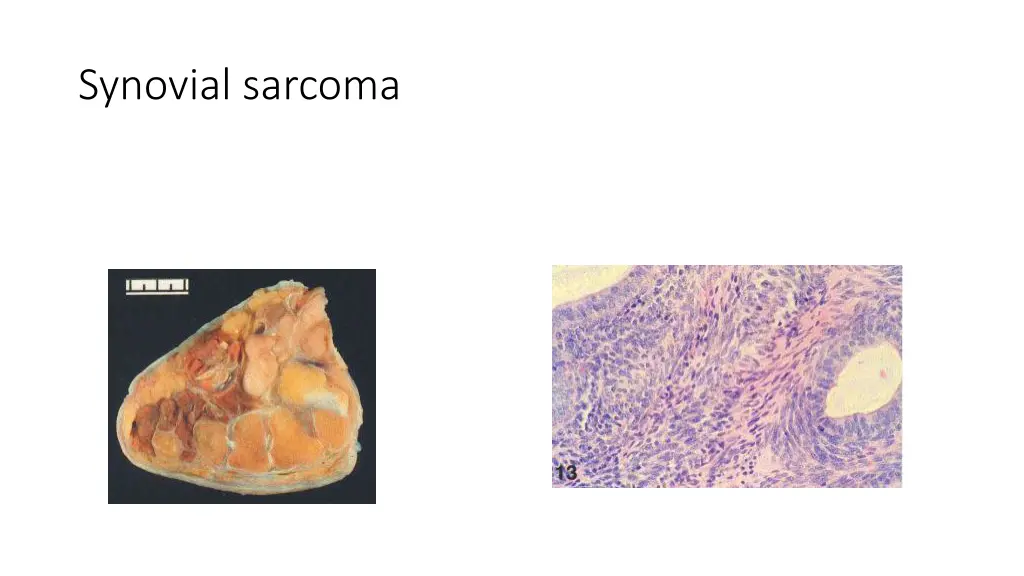 synovial sarcoma