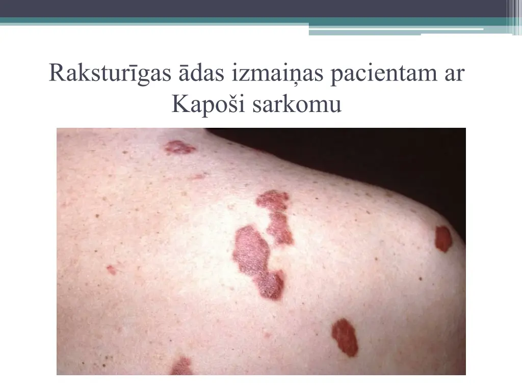 rakstur gas das izmai as pacientam ar kapo