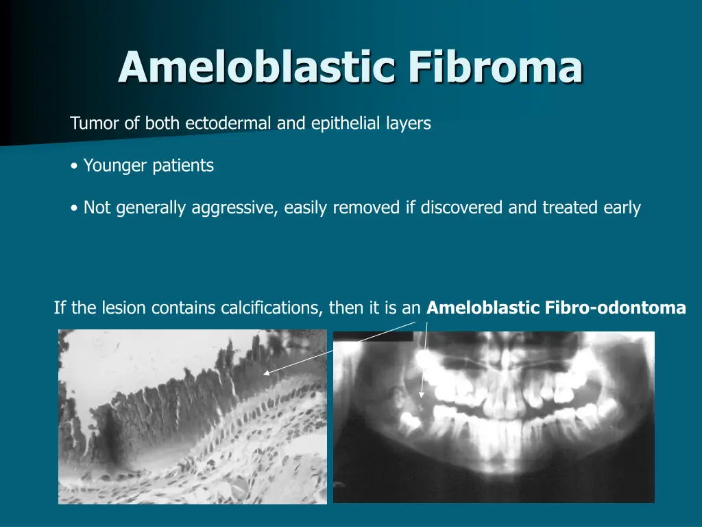 ameloblastic fibroma