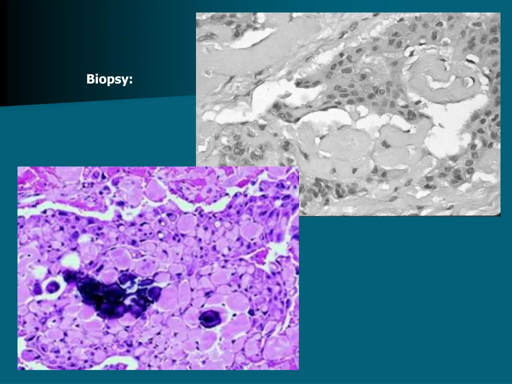 biopsy