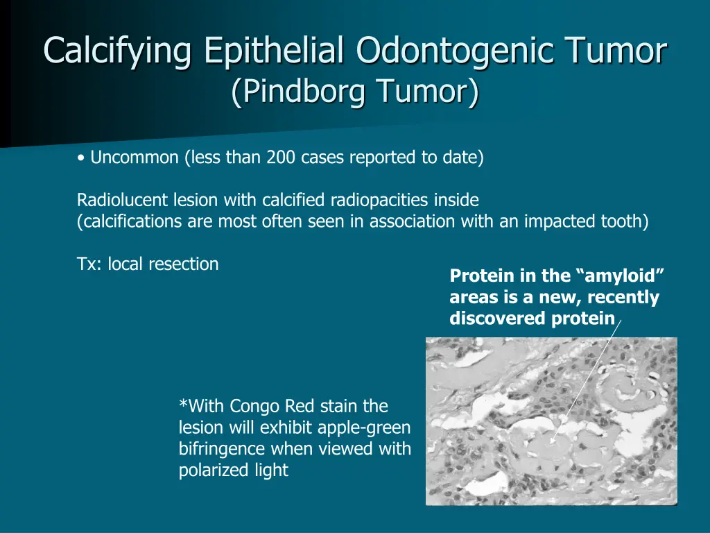 calcifying epithelial odontogenic tumor pindborg