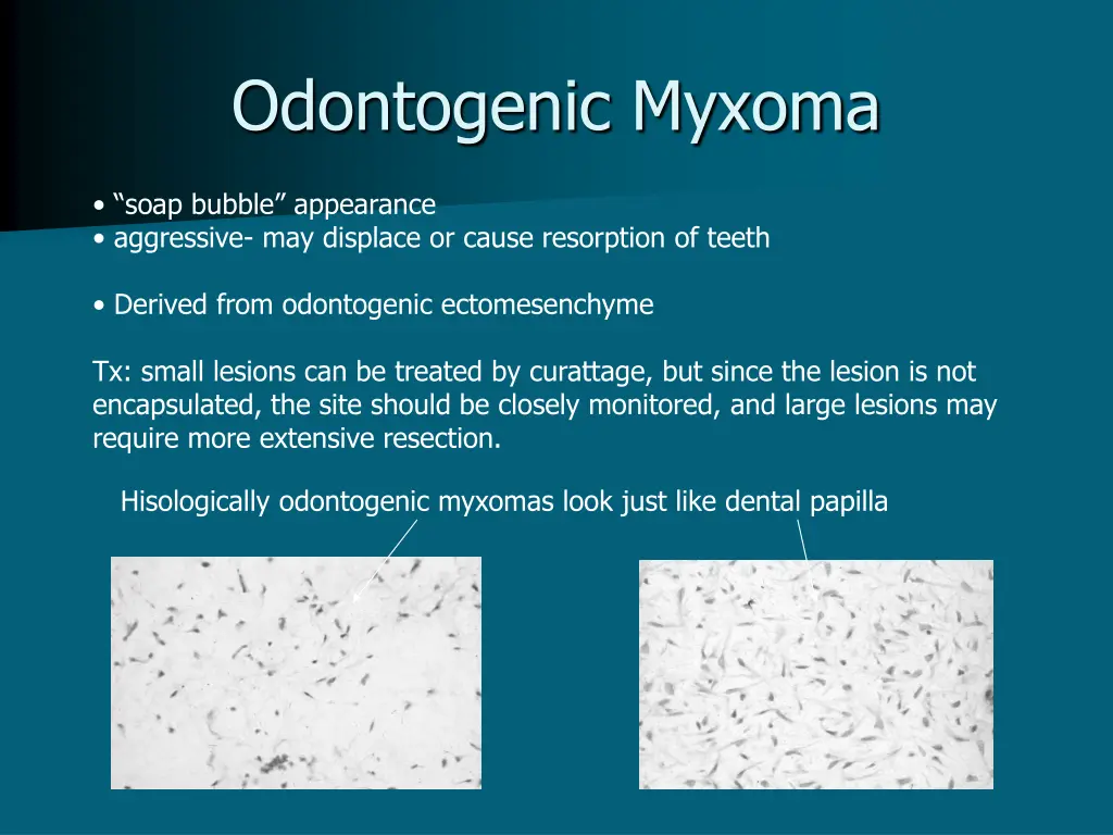 odontogenic myxoma