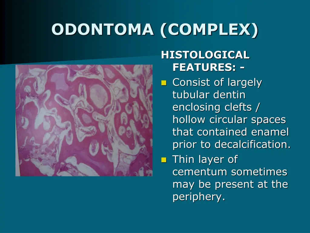 odontoma complex 1