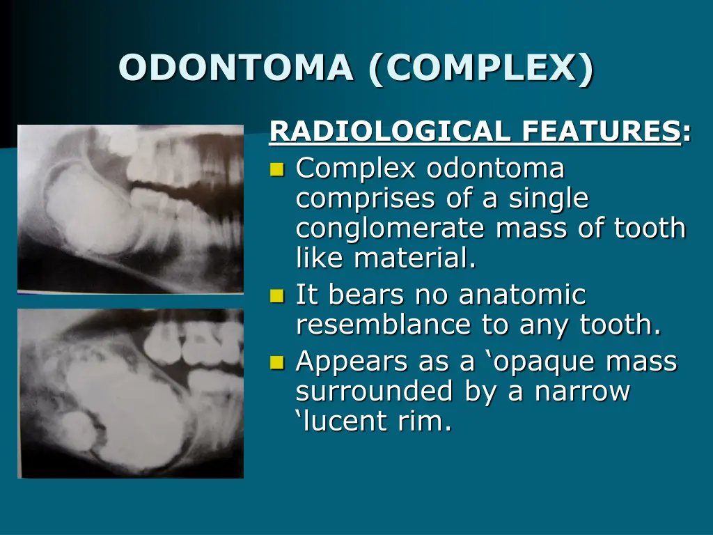 odontoma complex