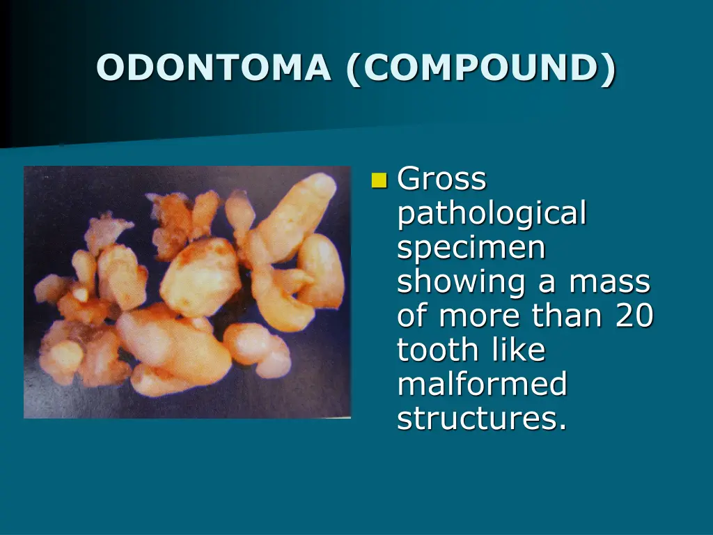 odontoma compound