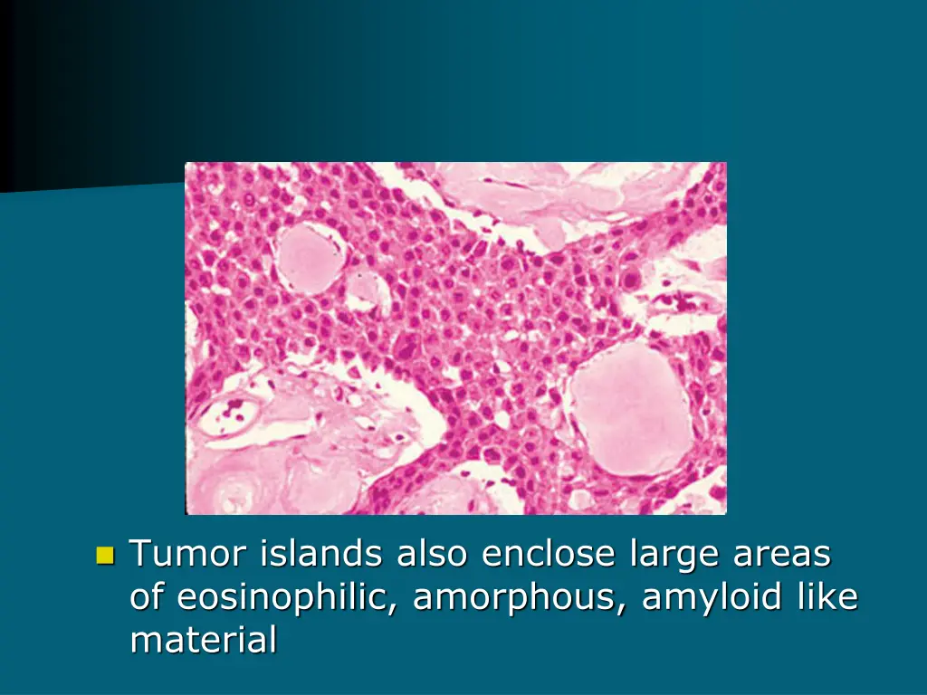 tumor islands also enclose large areas