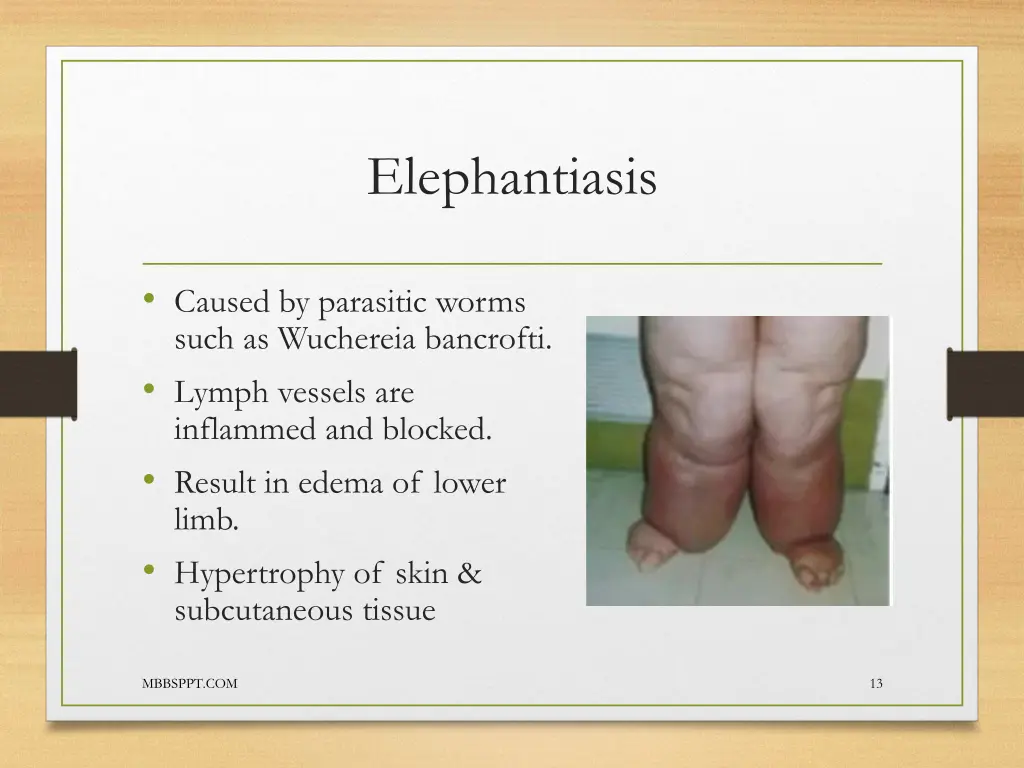 elephantiasis