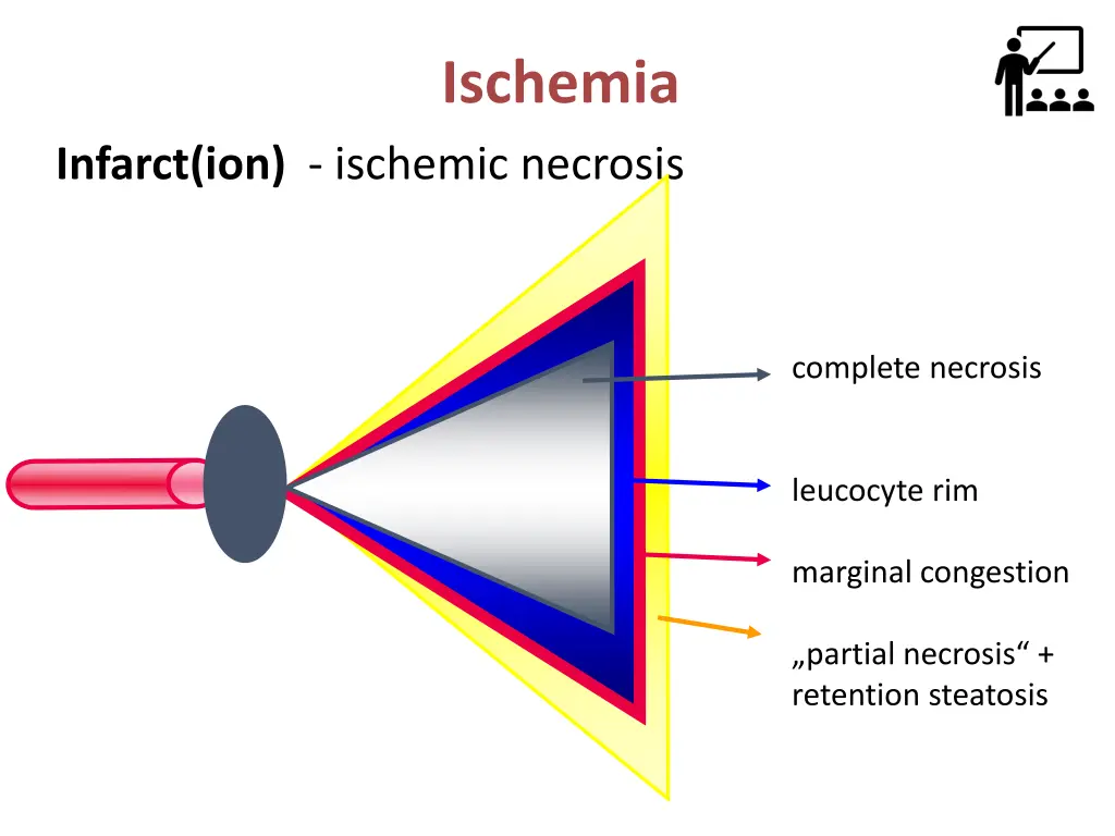 ischemia 2