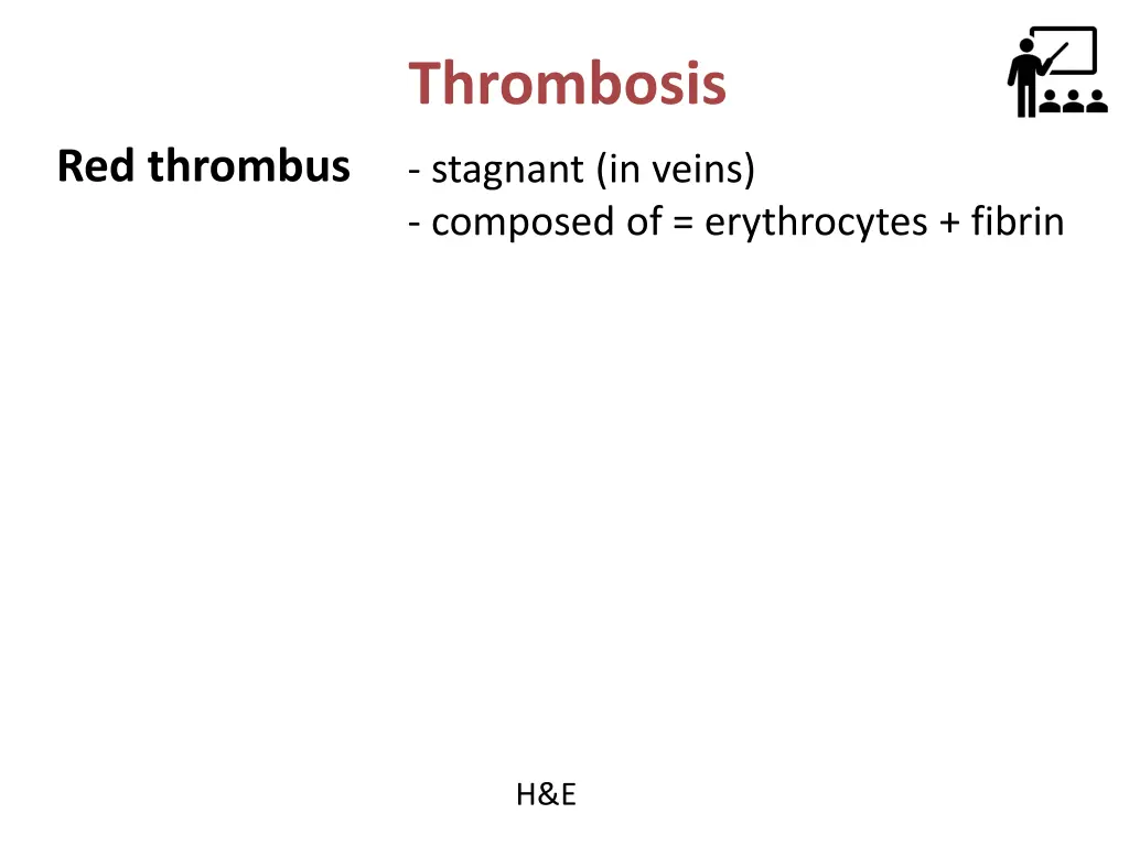 thrombosis 5