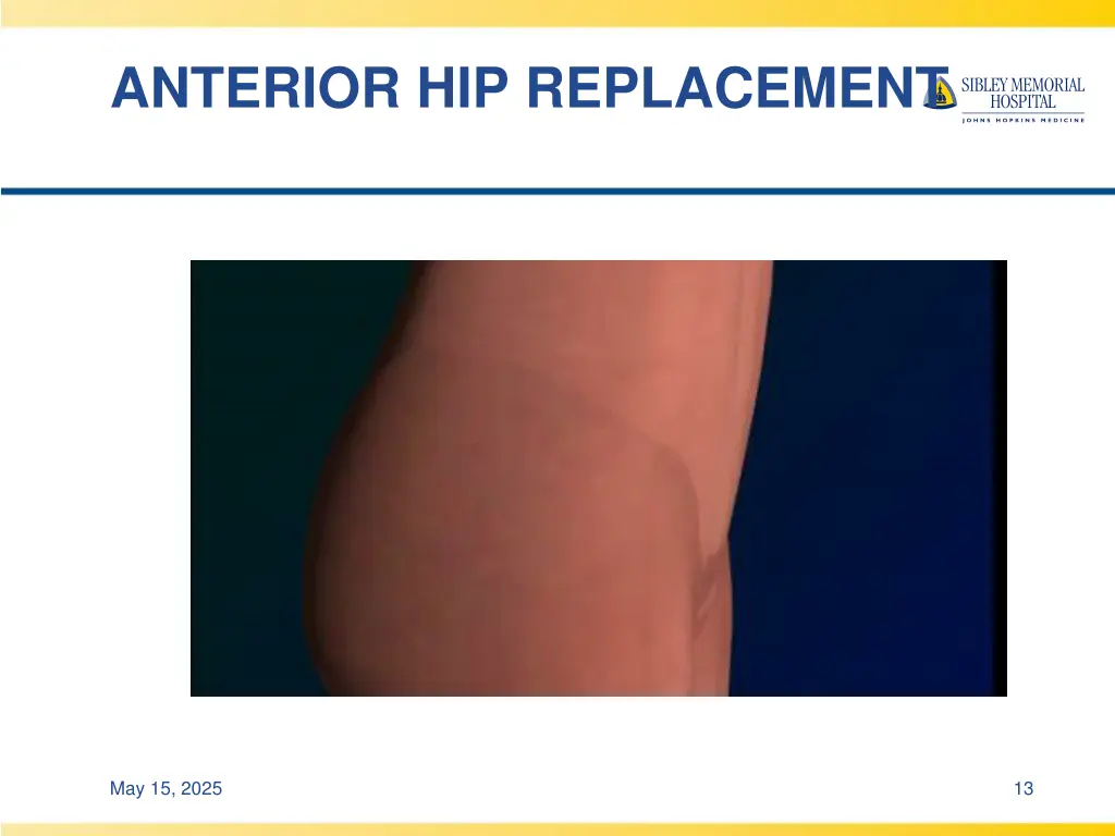 anterior hip replacement 1