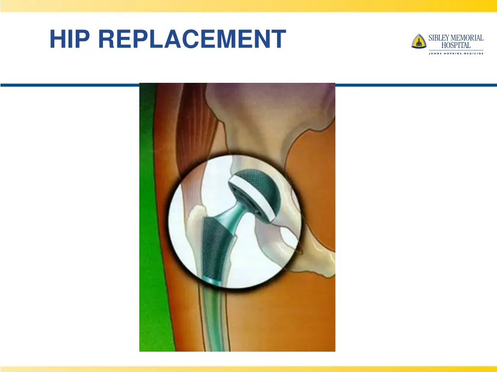 hip replacement