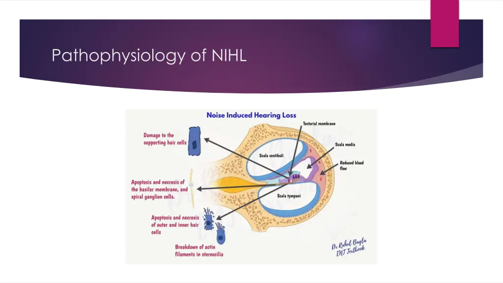 pathophysiology of nihl