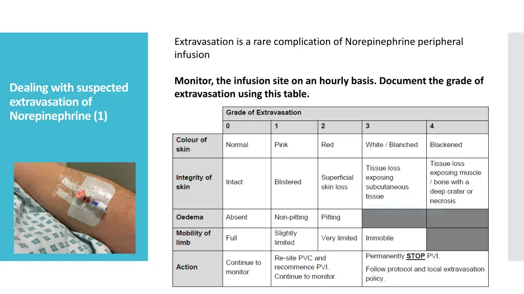 extravasation is a rare complication