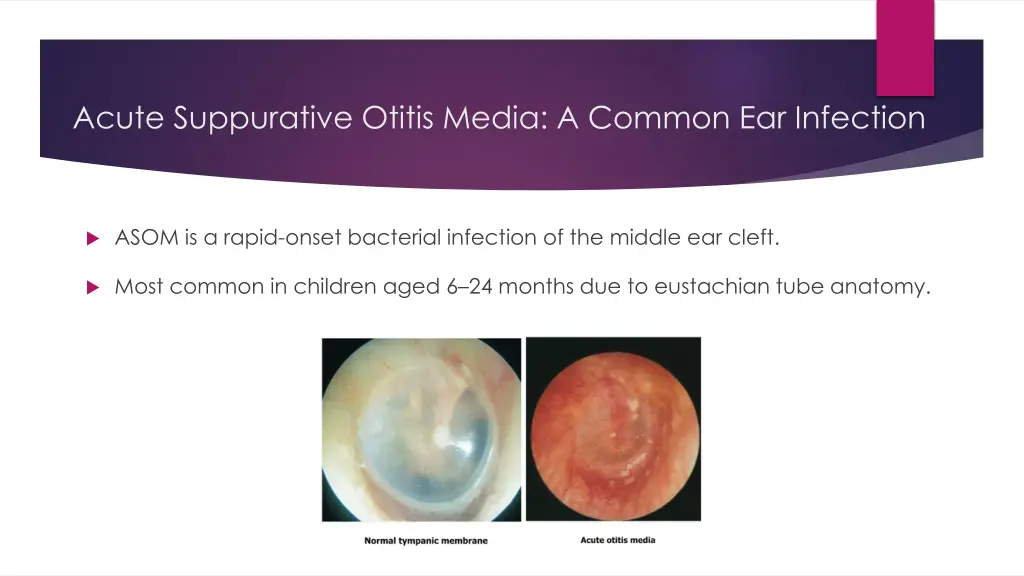 acute suppurative otitis media a common