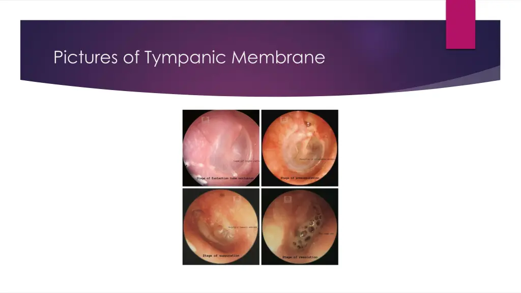 pictures of tympanic membrane