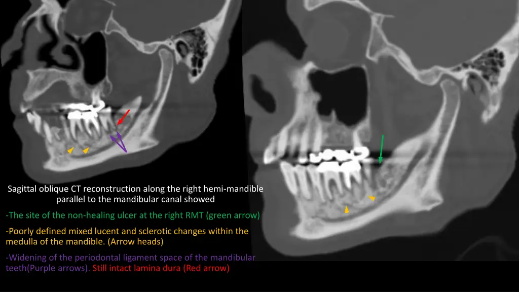 sagittal oblique ct reconstruction along