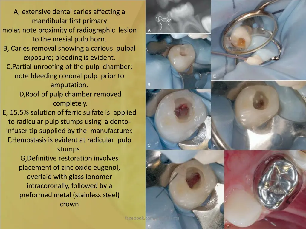 a extensive dental caries affecting a mandibular