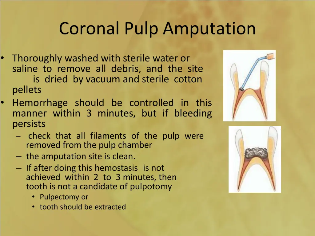 coronal pulp amputation 1
