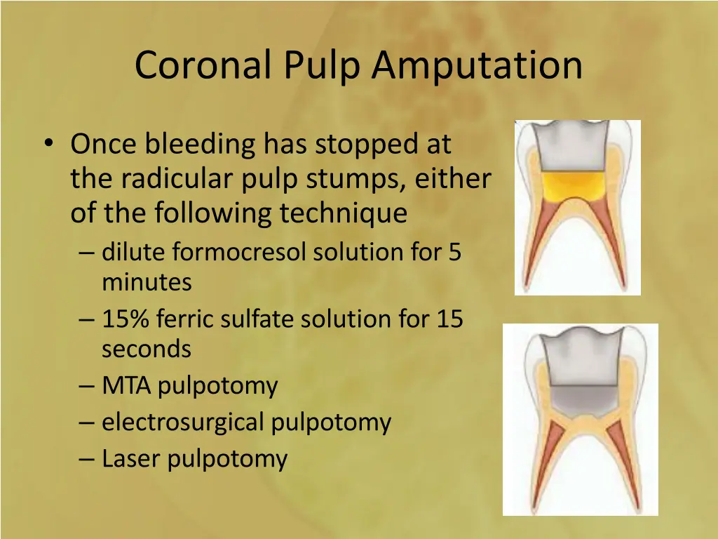 coronal pulp amputation 2