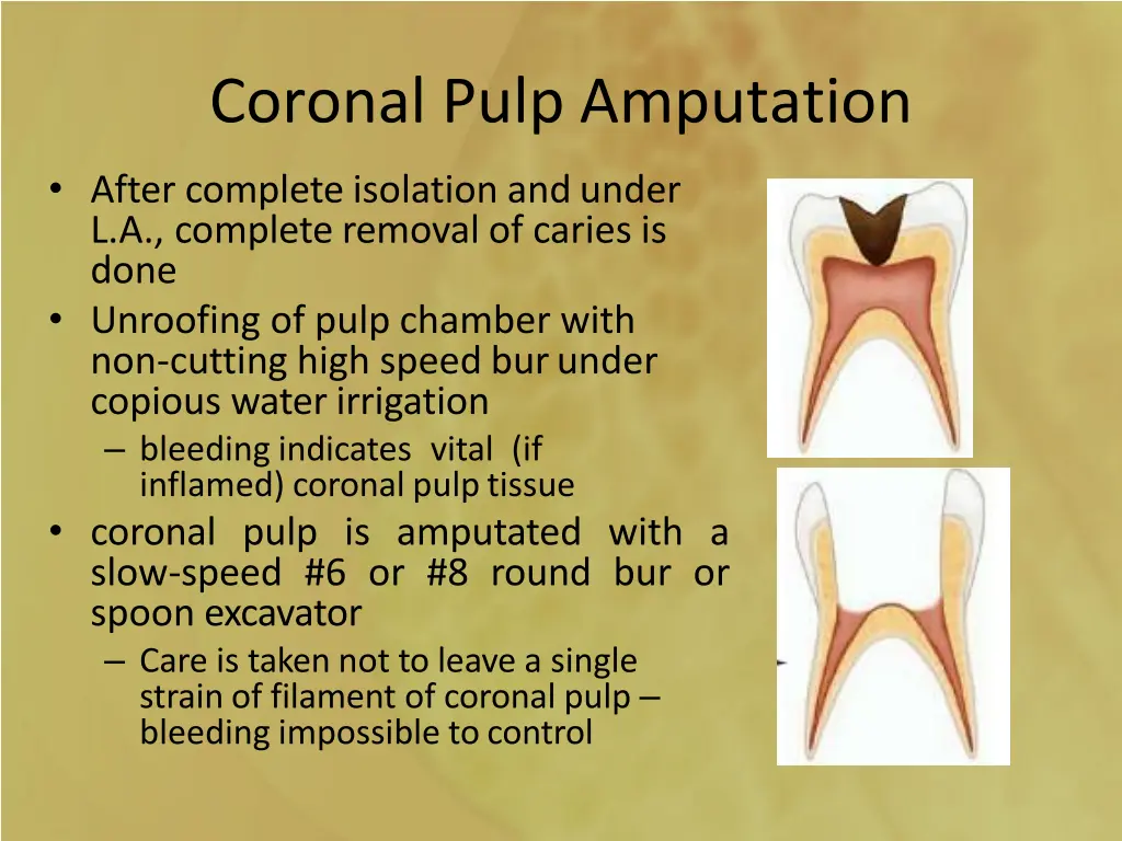 coronal pulp amputation