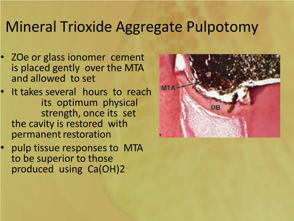 mineral trioxide aggregate pulpotomy