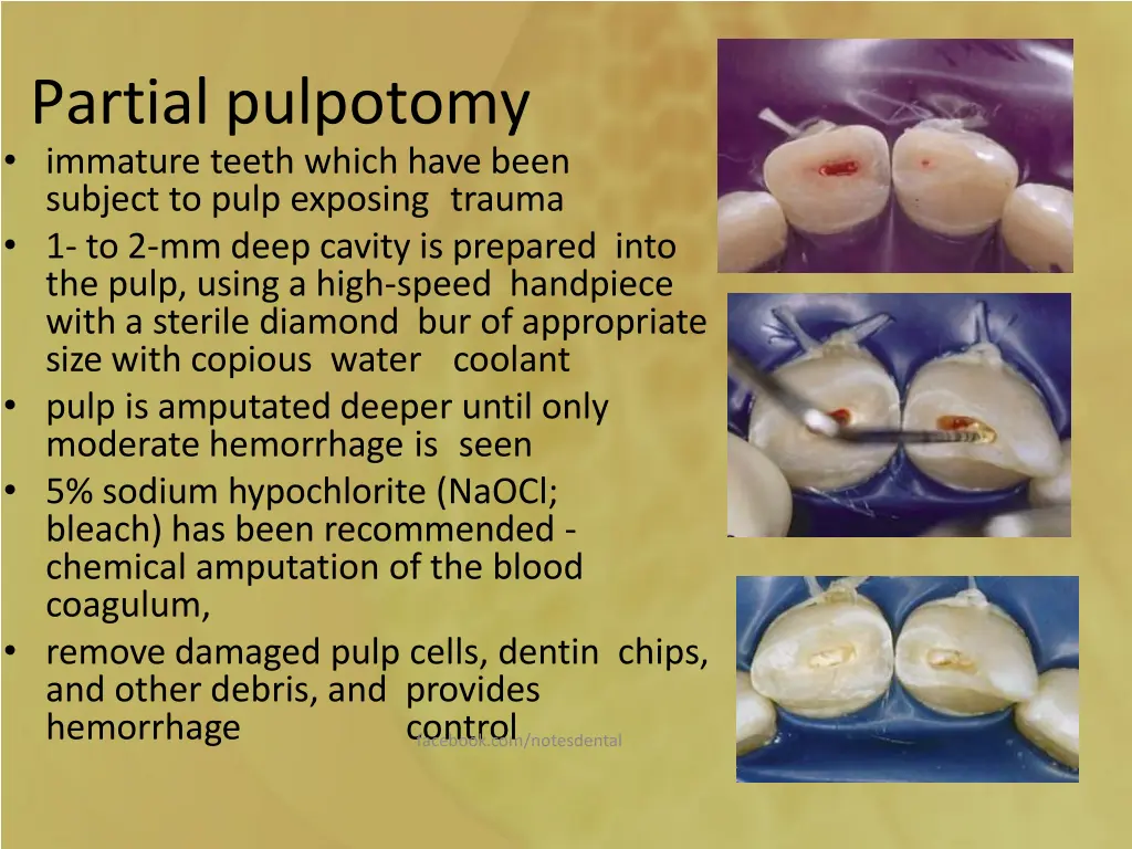 partial pulpotomy immature teeth which have been