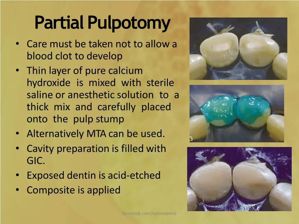 partialpulpotomy care must be taken not to allowa