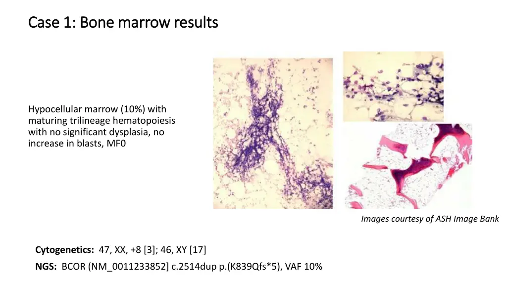case 1 b case 1 bone marrow results one marrow