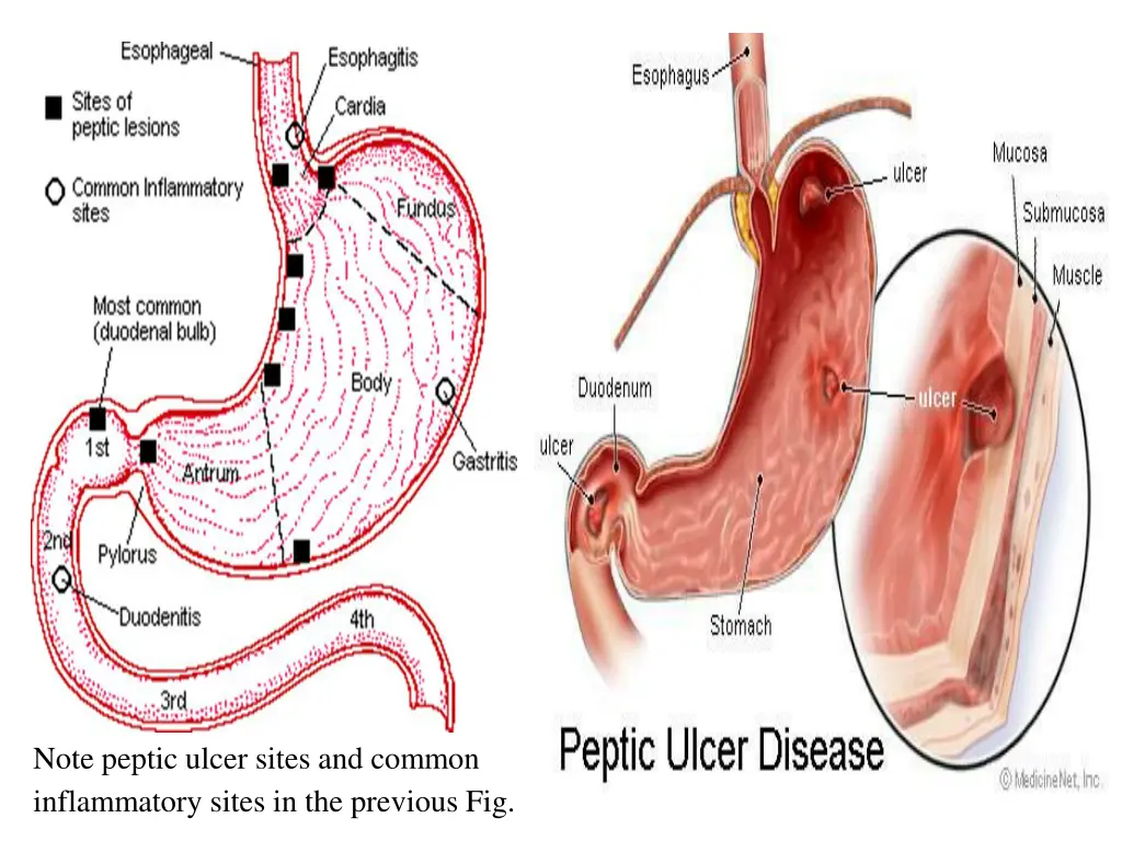 note peptic ulcer sites and common inflammatory