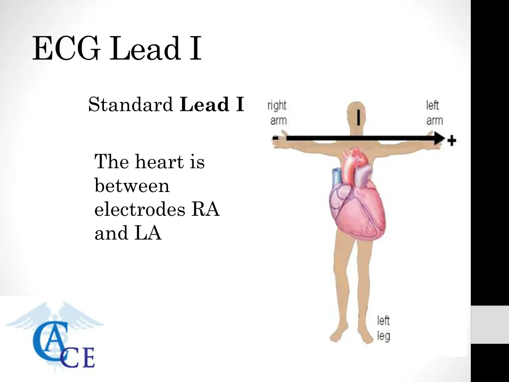 ecg lead i