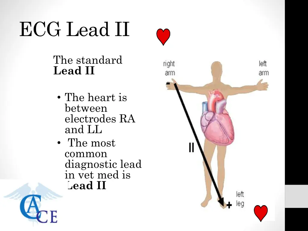 ecg lead ii