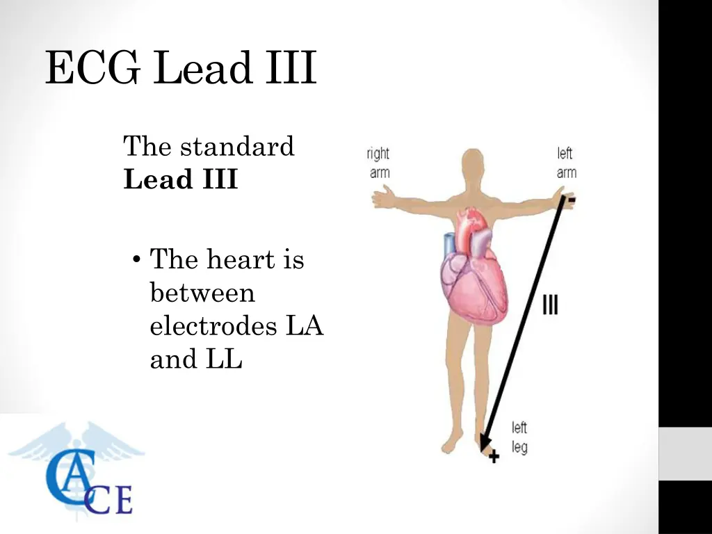 ecg lead iii