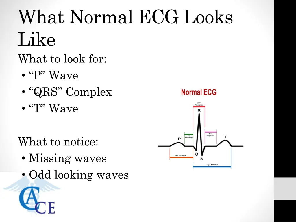 what normal ecg looks like what to look