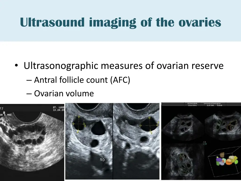 ultrasound imaging of the ovaries