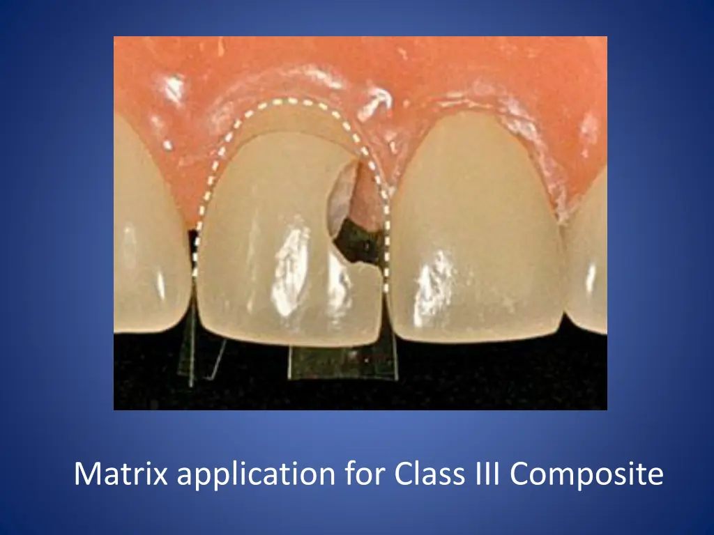 matrix application for class iii composite 1