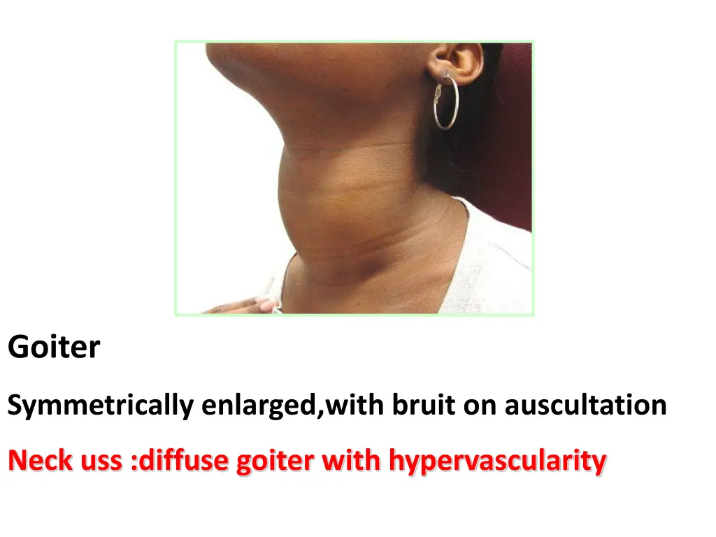 goiter