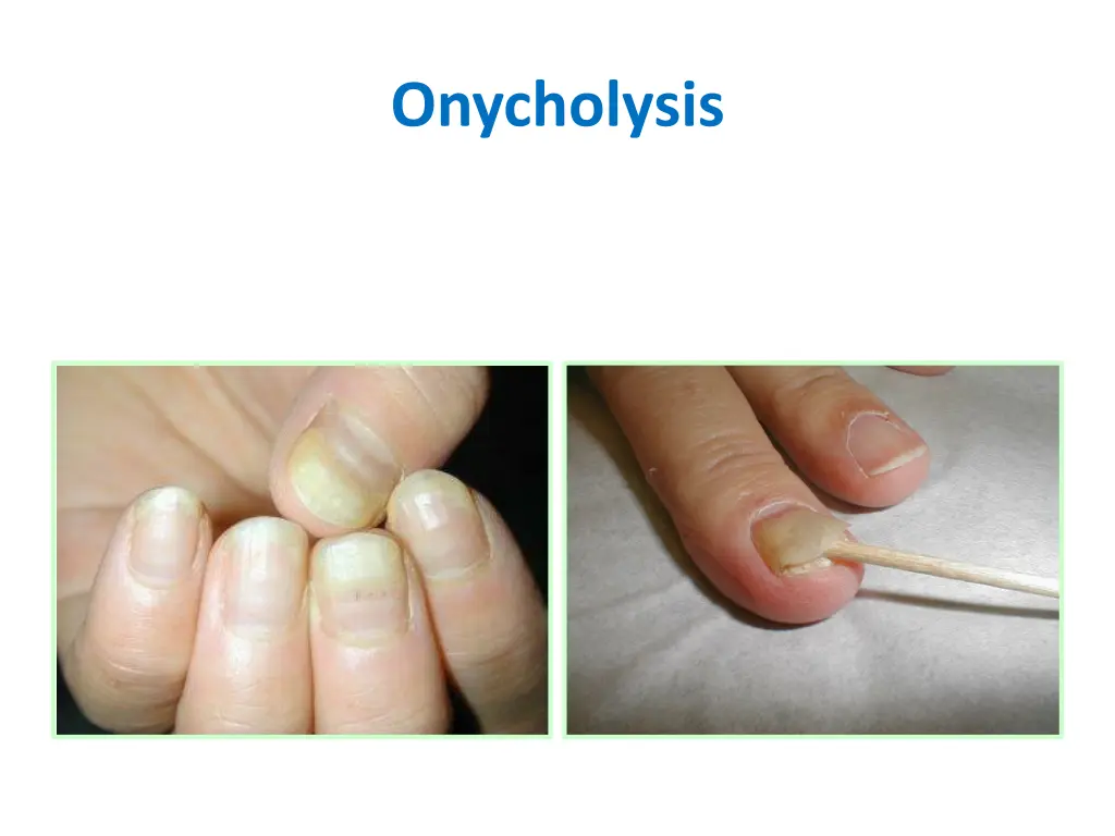 onycholysis