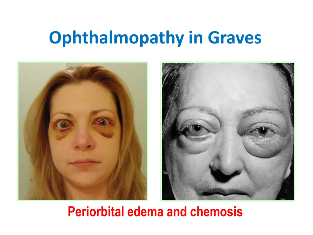 ophthalmopathy in graves