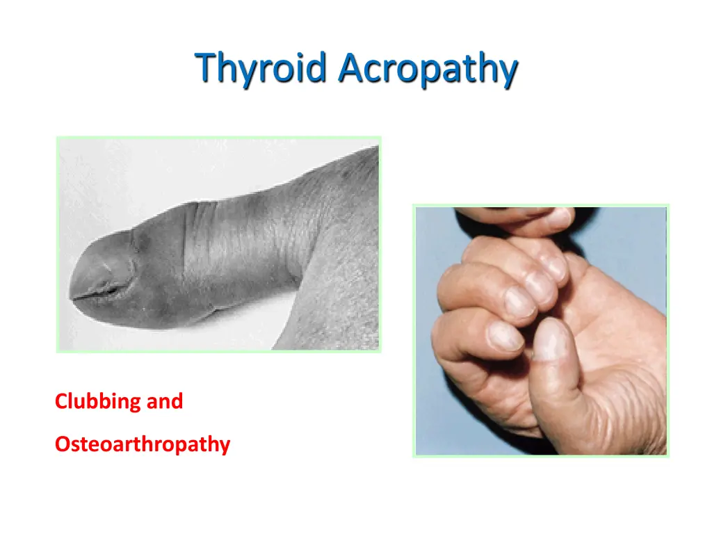 thyroid acropathy