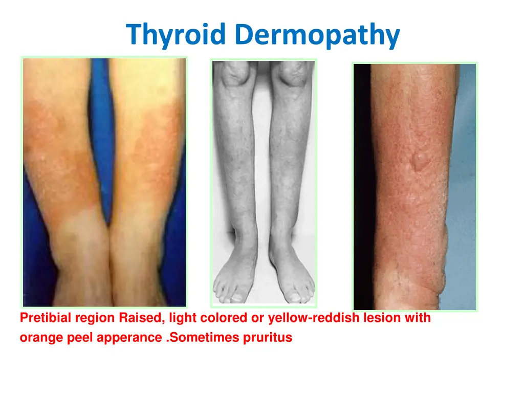thyroid dermopathy