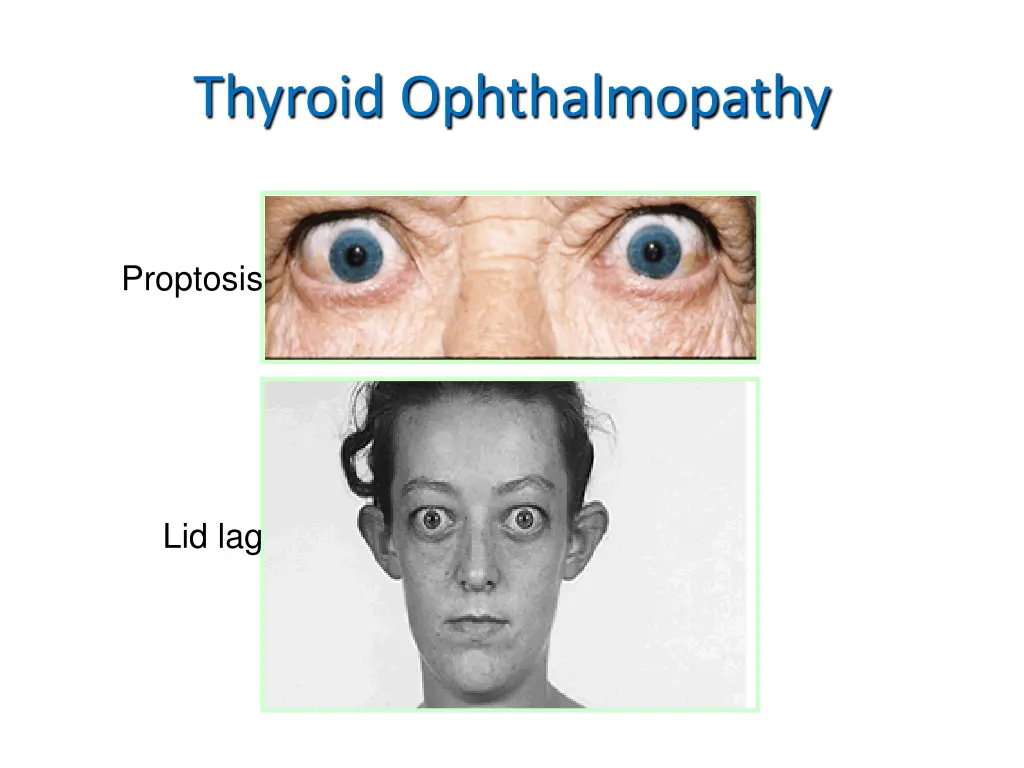 thyroid ophthalmopathy