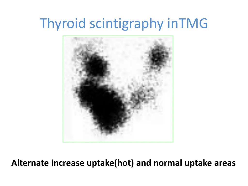 thyroid scintigraphy intmg