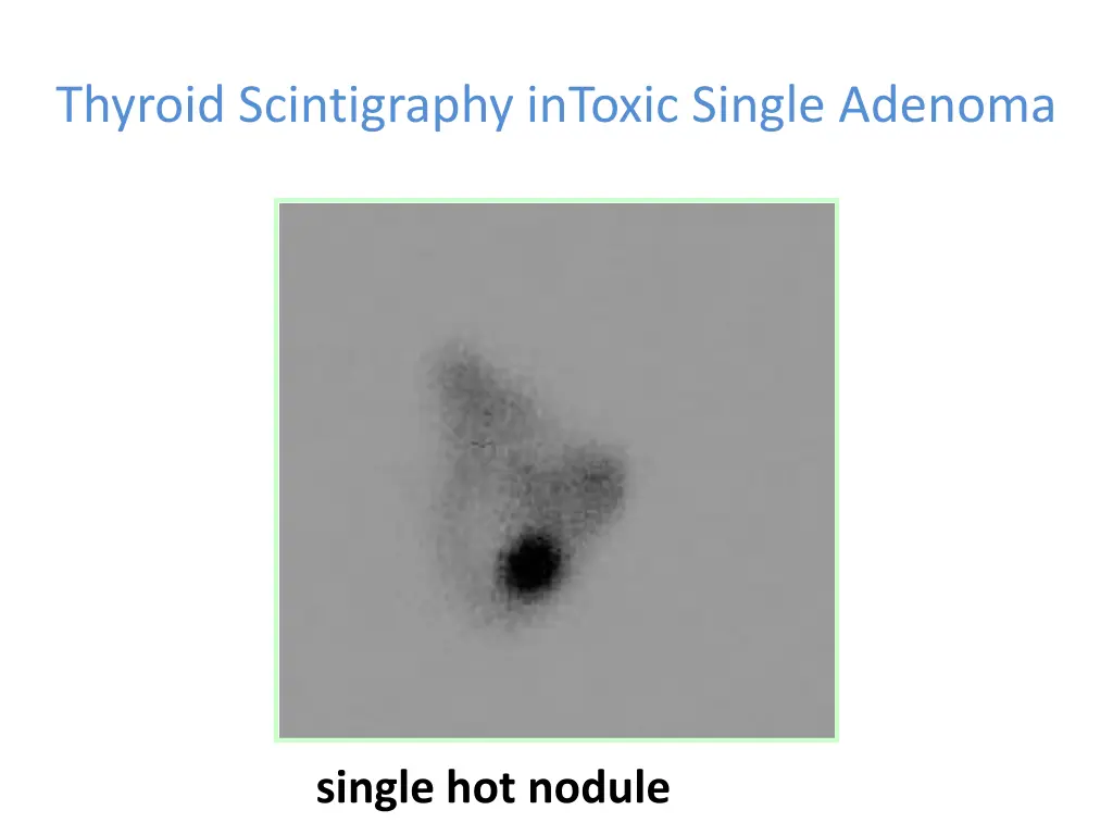 thyroid scintigraphy intoxic single adenoma