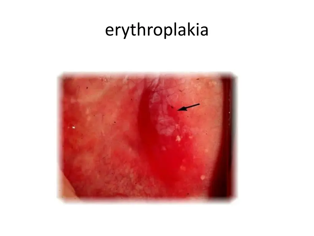 erythroplakia 1