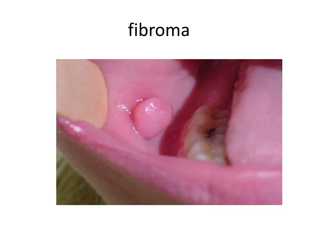 fibroma 2